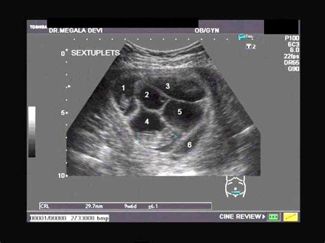 Pregnant With Quadruplets Ultrasound