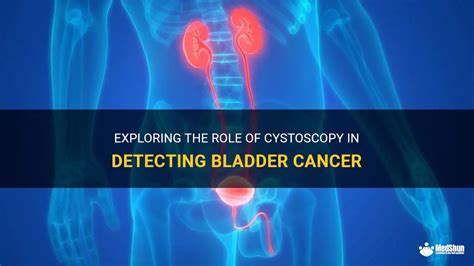 Exploring The Role Of Cystoscopy In Detecting Bladder Cancer | MedShun