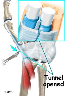 de Quervain’s Tenosynovitis - eOrthopod.com