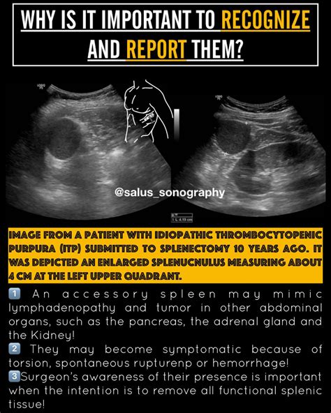 🔶SPLENUNCULUS, SPLENULE, SUPERNUMERARY... - Salus sonography