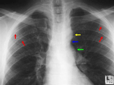 Aortic coarctation