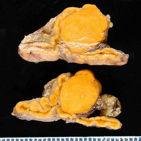 Adrenal Adenoma