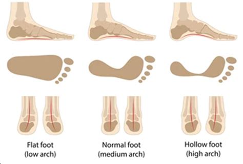 Do your Foot Arches make you more or less likely to be injured ...