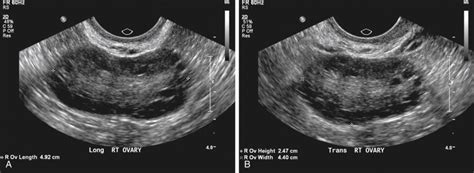 Normal Vs Polycystic Ovaries Ultrasound