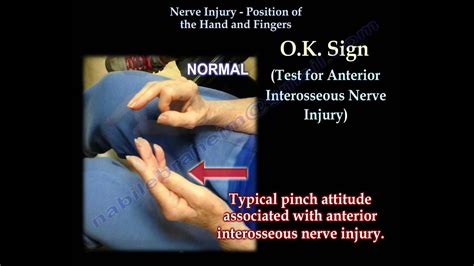 Median Nerve Palsy