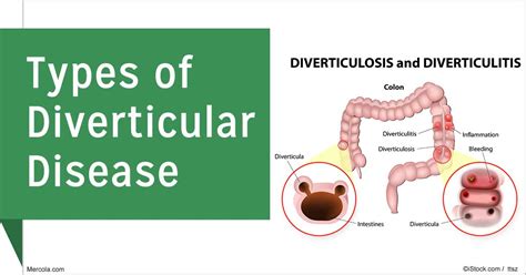 Naturally Navigating Diverticulitis: Effective Treatment Strategies ...