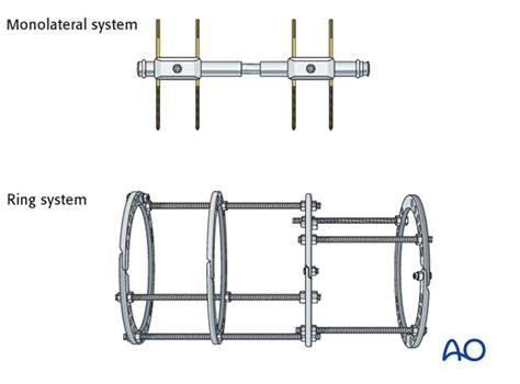 External fixation for Ulna, complete transverse, simple