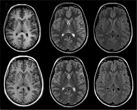 From left to right: T1, T2, and FLAIR-weighted conventional (top row ...