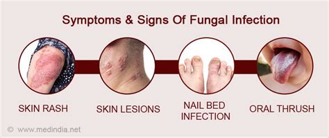 Fungal Infections - Causes, Symptoms, Diagnosis, Treatment & Prevention