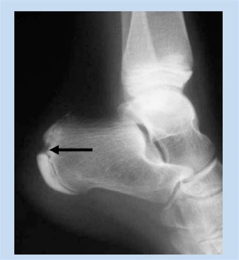 Lateral radiograph of the calcaneus demonstrates fragmentation and ...