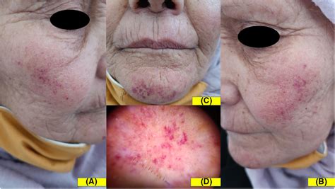 Rosuvastatin induced photolocalized purpura - Thabouti - 2022 ...