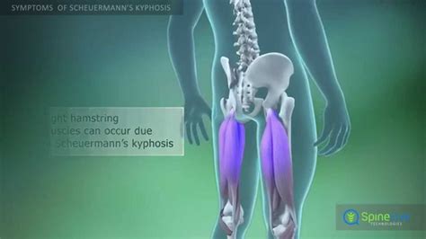 Scheuermann’s kyphosis Symptoms - YouTube