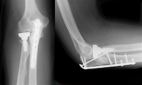 Complex Elbow Fracture Surgery | Arm Docs