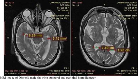 Figure 1 from Anatomical study of size variability of temporal and ...