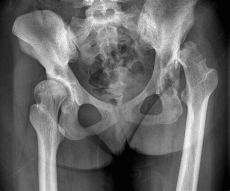 Developmental dysplasia of hips - Radiology at St. Vincent's University ...