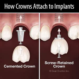 Screw or Cement: Which is Best for Attaching Your Implant Crown?