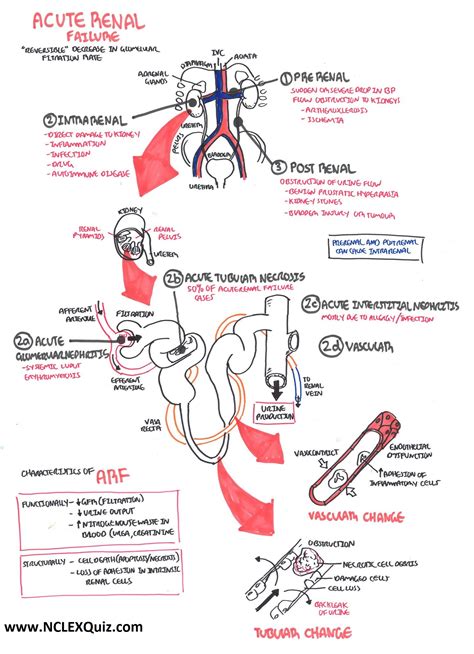 Pathophysiology Acute Renal Failure for Nursing Students - NCLEX Quiz