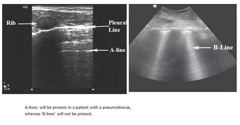 Ultrasonographic features of pneumothorax | Deranged Physiology