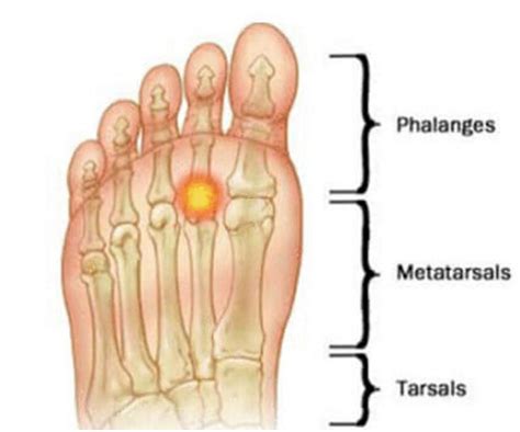 Condition Spotlight: Synovitis - Watsonia Podiatry