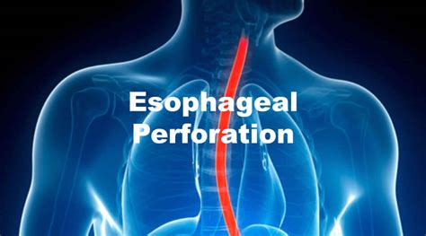 What Are The Symptoms Of A Hole In Esophagus - A Pictures Of Hole 2018