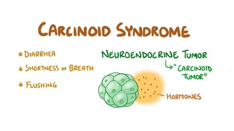 Carcinoid syndrome: Video, Anatomy & Definition | Osmosis