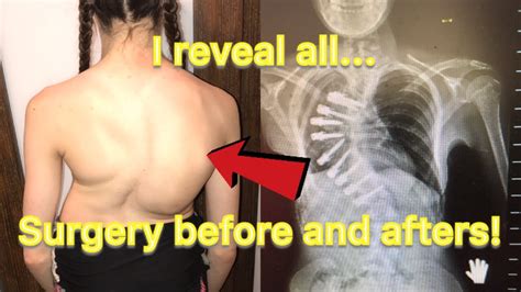 Scoliosis surgery before and afters - I reveal all... - YouTube