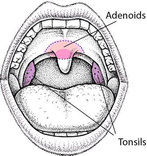 Quick Facts: Enlarged Tonsils and Adenoids - MSD Manual Consumer Version