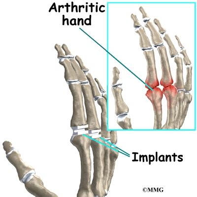 Artificial Joint Replacement of the Finger - Orthopedic Surgery ...