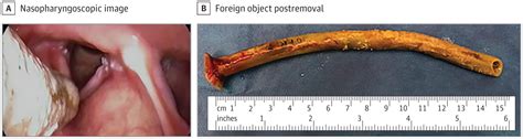 Retained Nasal Trumpet for 20 Months: An Unusual Foreign Body ...