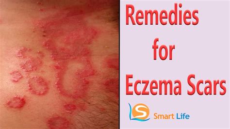 Best Home Remedies For Eczema Scars Treatment | Home Remedies For ...