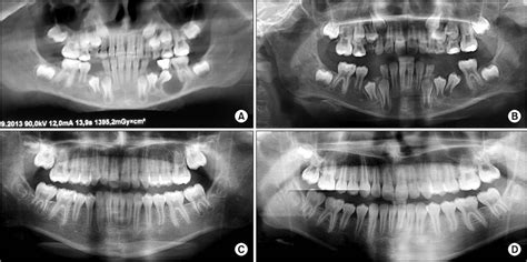 Panoramic radiographs. A. Radiograph view demonstrating the dentigerous ...