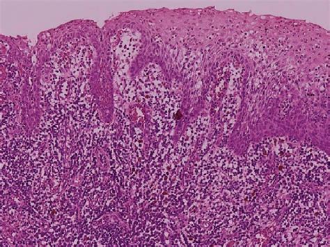 Gingival Hyperplasia Histology