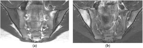 Sacroiliac Joint Erosion