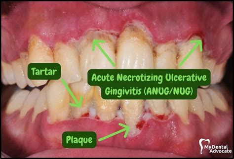 Gingivitis vs Healthy Gums