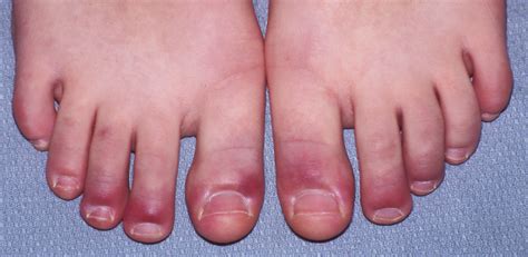 Idiopathic Raynaud Disease | Consultant360