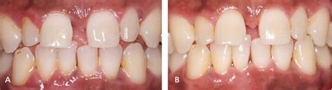 Successful Strategies for Periodontal Debridement