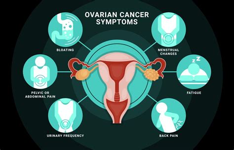 infographie sur les symptômes du cancer de l'ovaire 3107732 ...