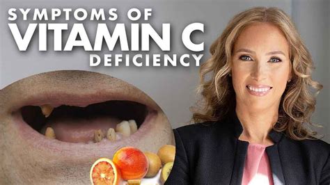 Plochý jar T vitamin c deficiency symptoms dohľad spolužiak štandardné