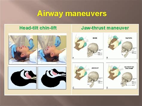 Head Tilt Chin Lift Maneuver Vs Jaw Thrust