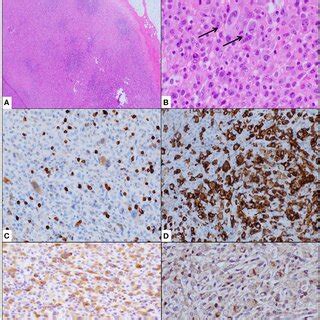 Cervical lymph node biopsy showed effacement of architecture (A) with ...