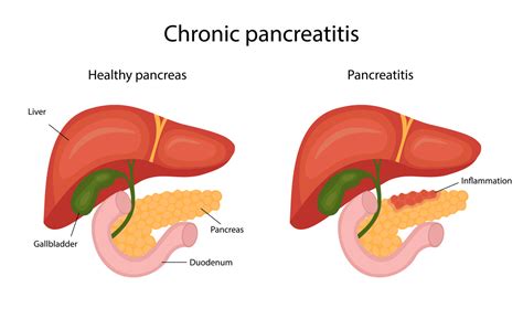 What Is Pancreatitis? | PainScale