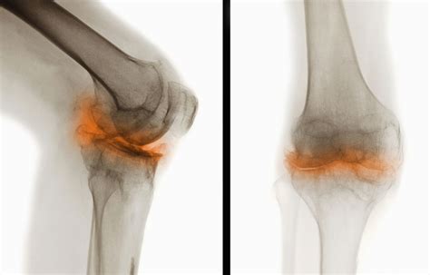 Pictures of Osteoarthritis: Locations, Symptoms, Diagnosis