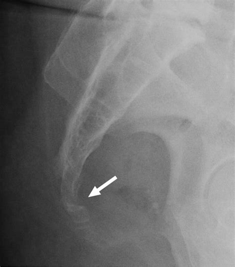 Sacrum and Coccyx Radiographs Have Limited Clinical Impact in the ...