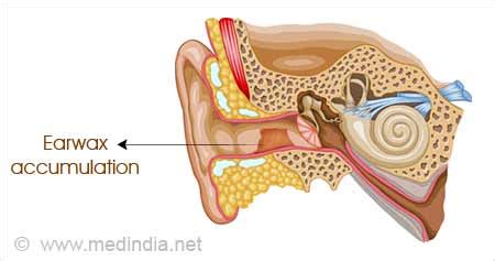 The Anatomy Of Ear Wax