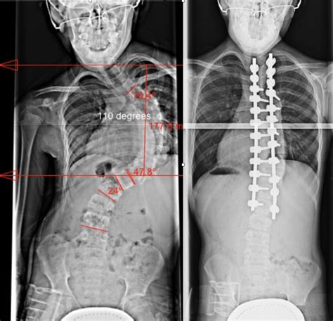 Dr. Lloyd Hey's Blog: Scoliosis and Spine Care, Aviation Safety and ...