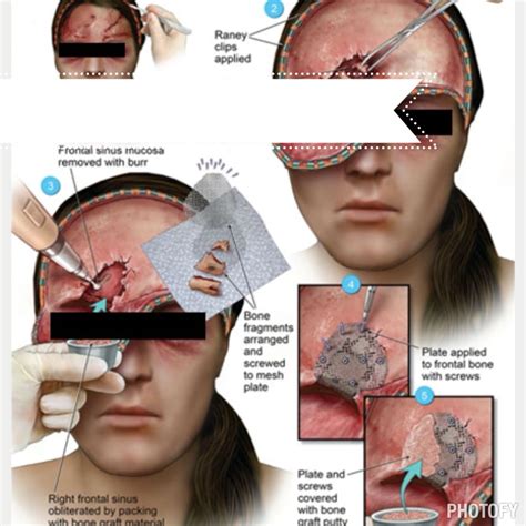 Sinus Obliteration Surgery | Sinusitis, Surgery, Frontal