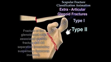 Scapular Fracture Classification Animation - Everything You Need To ...