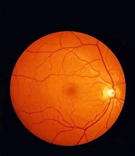 Retinal detachment: causes, symptoms and treatment | Vision 2024