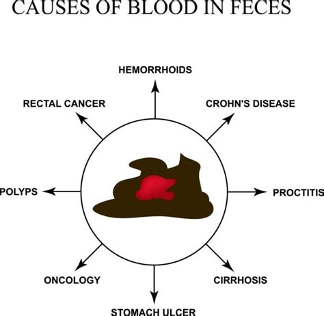 Causes Of Blood In Stool | STD.GOV Blog