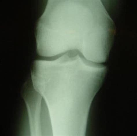 The Normal Knee X-ray: What Are the Different Views?